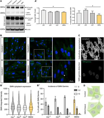 A Compound Heterozygous Mutation in Calpain 1 Identifies a New Genetic Cause for Spinal Muscular Atrophy Type 4 (SMA4)